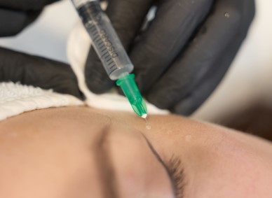 Биоревитализация