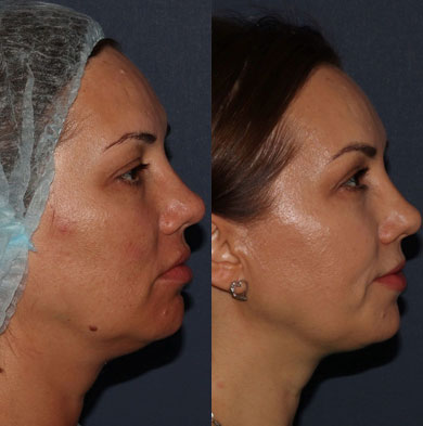 Фото результата биоревитализации лица у женщины 40 лет: глаза больше не выглядят уставшими, исчезла асимметрия, кожа выглядит обновленной и стала ровной, а уголки рта подтянуты.