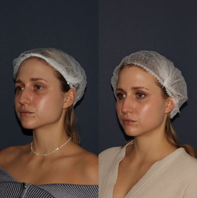 Эффект омоложения периорбитальной области инъекциями коллагена в косметологической клинике Renuvo во Владивостоке.