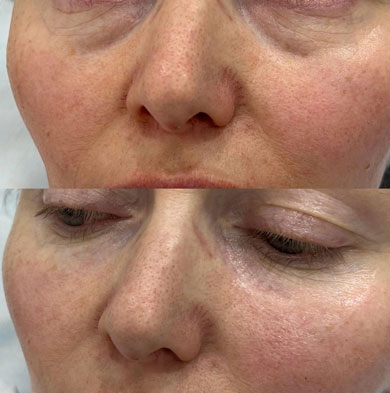 До и после коллагеностимуляции глаз - избавление от гусиных лапок и темных кругов. Результат инъекционной коллагенотерапии под глазами для повышения тургора кожи.