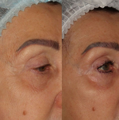 Фото результата RF-лифтинга зоны вокруг глаз: исчезли мешки, расгладились морщины, кожа стала ровной и выглядит здоровее.,  