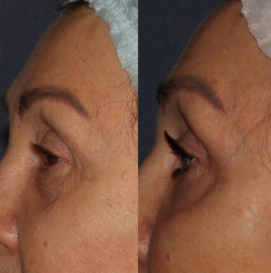 Фото результата RF-лифтинга зоны вокруг глаз у женщины 50 лет: исчезли мешки, расгладились морщины, кожа стала ровной и выглядит здоровее.,  